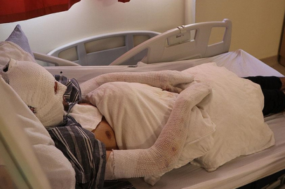 Erzurum'da otomobildeki çakmak tüpü patladı, 2 kişi yaralandı