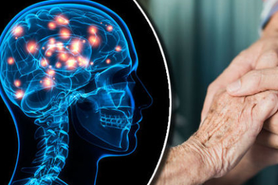 İngiltere'de, daha önce kesin çaresi olmayan Huntington hastalığı için tedavi geliştirildi
